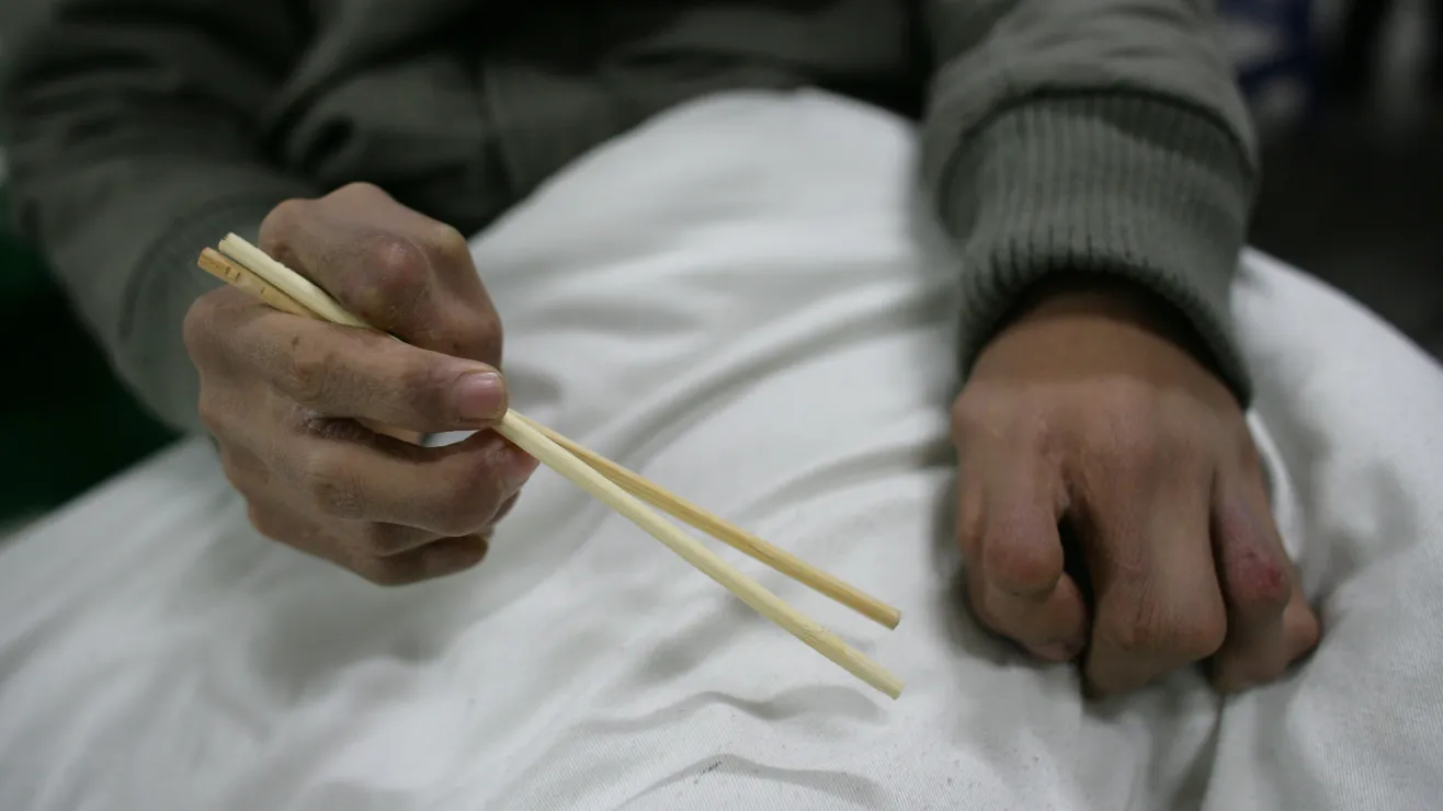 Vietnamese Patient&#8217;s Severe Headaches Linked to Brain-Embedded Chopsticks, Transatlantic Today