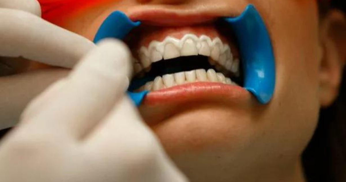 Is Teeth Whitening Illegal For Non Dentists? Understanding The Licensing Requirements, Transatlantic Today
