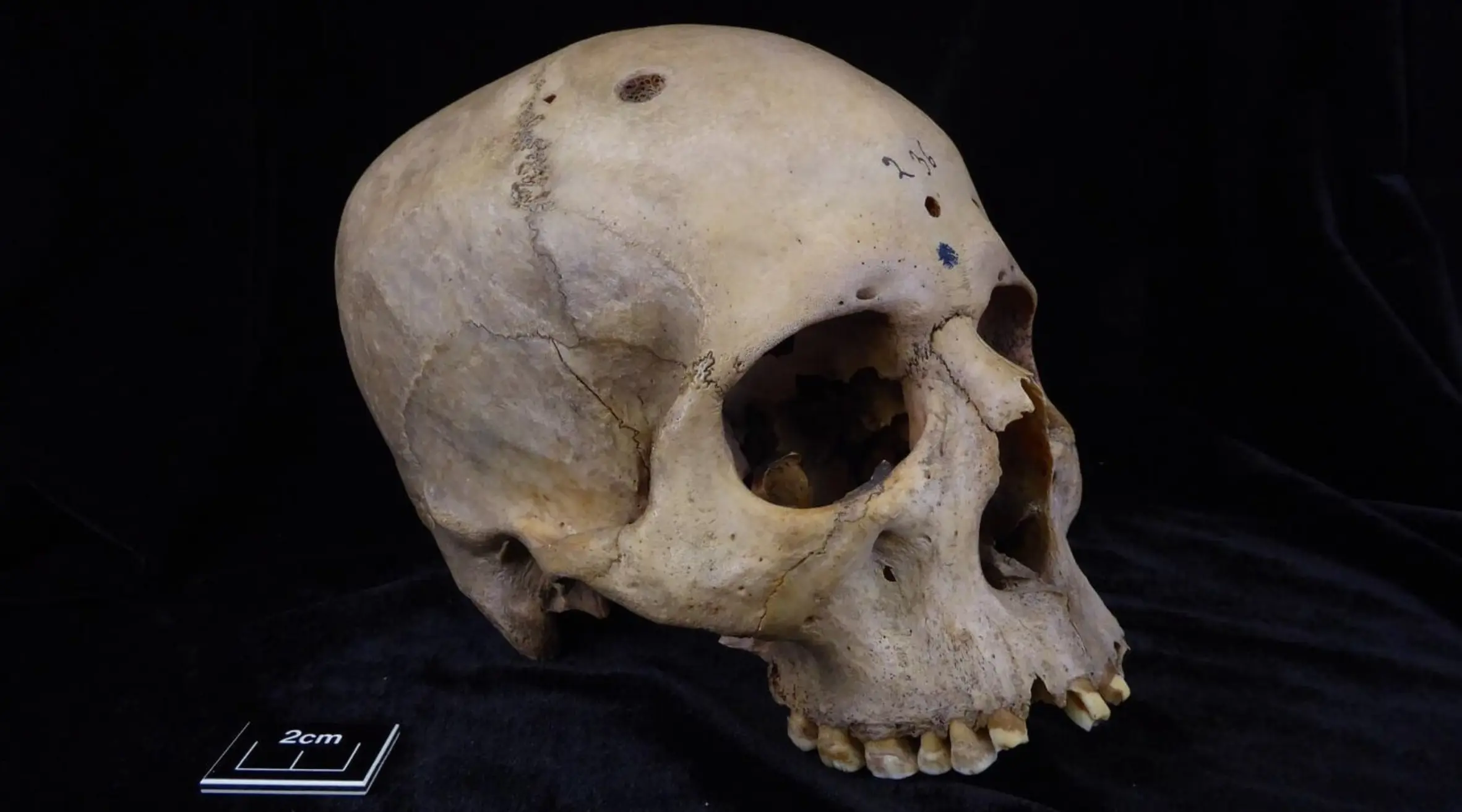 Ancient Egyptian Skull Reveals Early Cancer Surgery